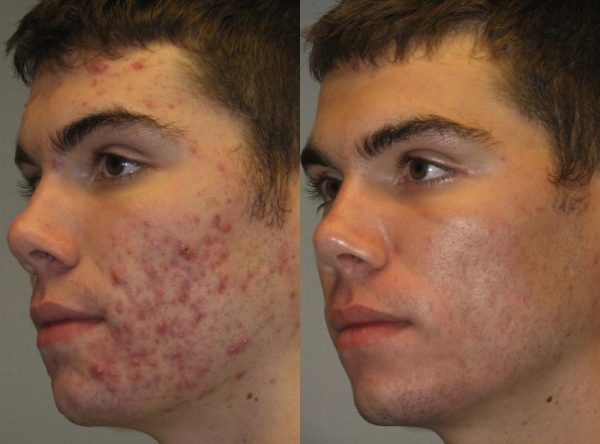 CLEAR DERM ACNE CREAM, SCARS & BLEMISH CREAM - Image 2