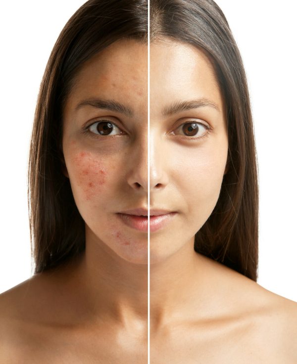 Skincleanze plus+ Blackhead Cream - Image 3